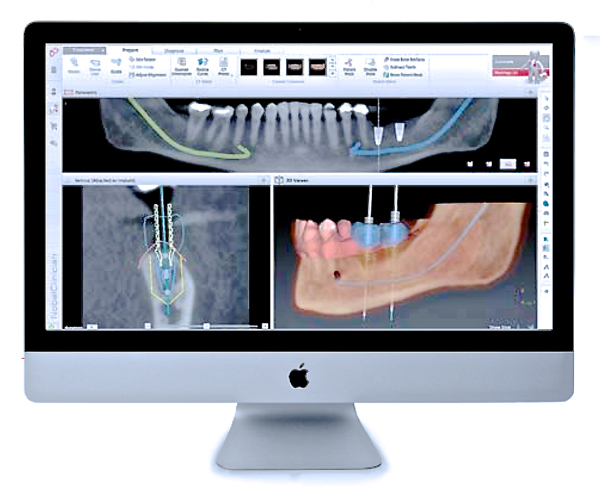 インプラントを植立する場所をシュミレーションする時代ティース teethナビゲーション
