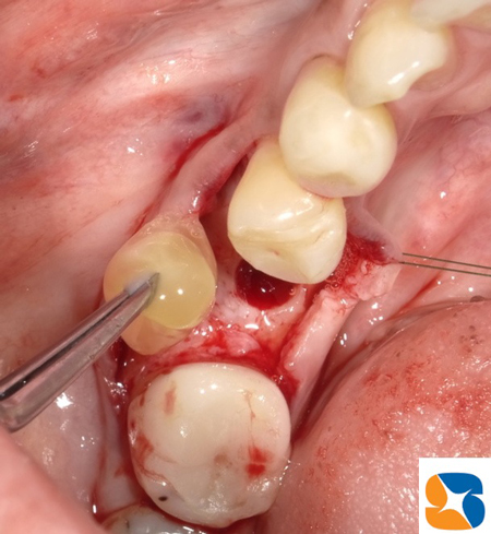 CGFを入れてからインプラントを植立　痛みや腫れを大幅に軽減する効果