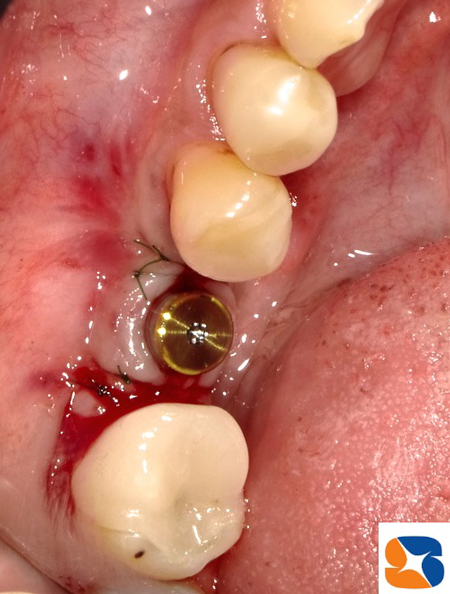 最先端のインプラントパーツを使用