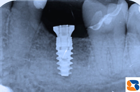 On1アバットメント