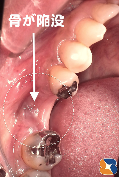 抜歯で骨の陥没　インプラント不向きのアゴ骨状態
