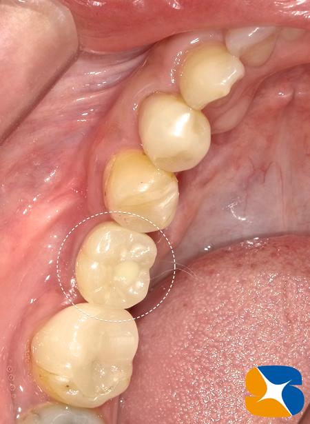 無痛　無料の静脈麻酔鎮静　インプラント　大阪