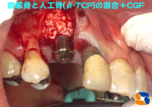 人工の骨　フィブリンゲルCGF無料