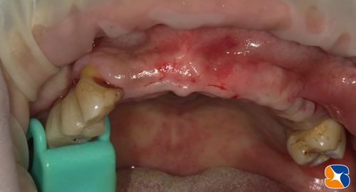 ブリッジ　入れ歯　インプラント　静脈麻酔鎮静法付きのインプラント　無痛　不安なし　