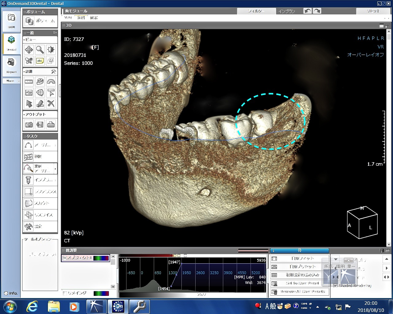 横向き　親知らず　難しい抜歯　テルプラグ代用
