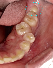 横向き　親知らず　難しい抜歯　テルプラグ代用
