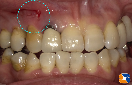 歯茎の悩み　腫れ　揺れ　白い膿み　