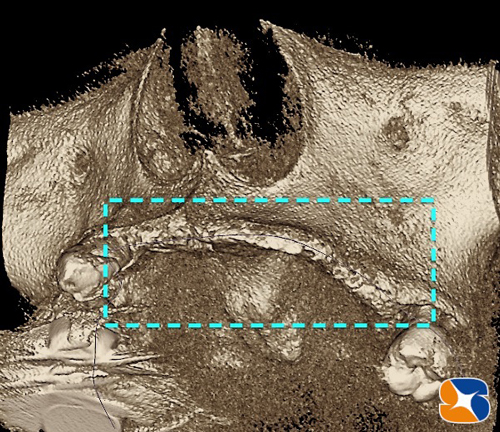 前歯の骨が薄くなっている　静脈麻酔鎮静法　奈良　生駒　無痛　恐くないインプラント手術