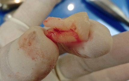 横向き　親知らず　難しい抜歯　テルプラグ代用