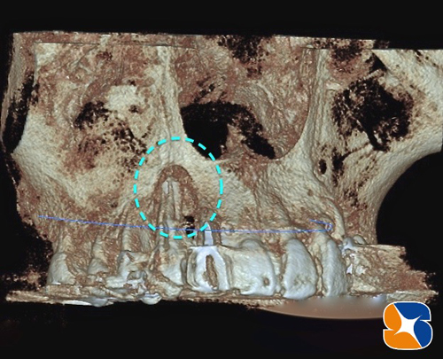歯科用CT　骨質精査　インプラント