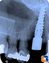 ノーベルバイオケア社　アクティブ