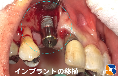 抜歯した日にインプラントを移植　骨の増加