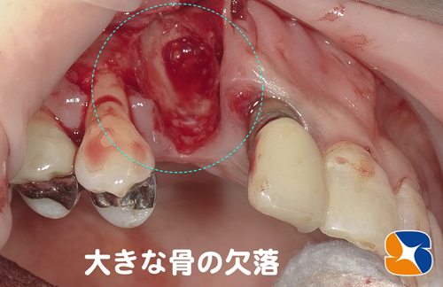 大きく骨の欠落　インプラント困難