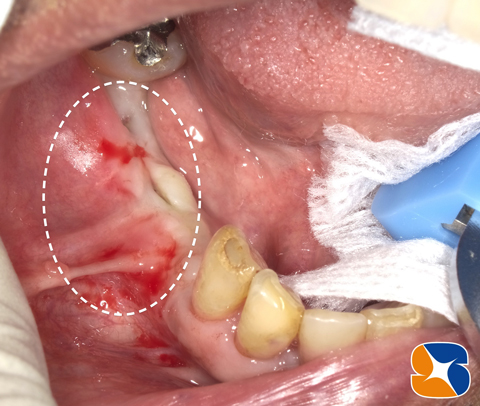 奈良　生駒　大阪　インプラント　静脈麻酔点滴　再生療法　悩み相談
