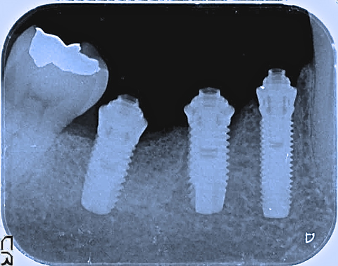 奈良　生駒　大阪　インプラント　点滴　再生療法　悩み相談