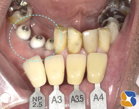 奈良　生駒　大阪　インプラント　点滴　再生療法　悩み相談