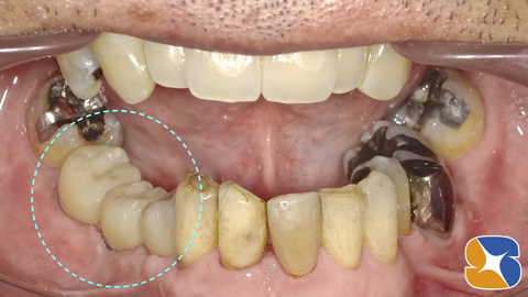 奈良　生駒　大阪　インプラント　静脈麻酔点滴　再生療法　悩み相談