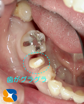 静脈麻酔鎮静法　生駒　奈良　石切　インプラント