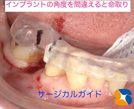 安全なインプラント　正確なポジションのインプラント　アフターケアーを考慮した設計