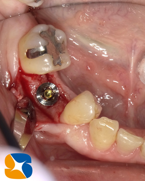 安全なインプラント　正確なポジションのインプラント　アフターケアーを考慮した設計