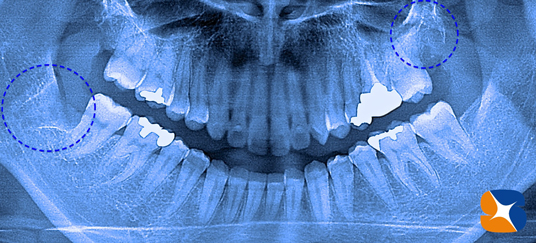 横向きの親知らず　静脈麻酔鎮静　保険　大阪　奈良