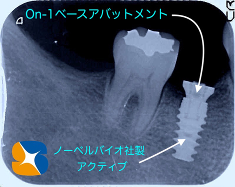 安全なインプラント　正確なポジションのインプラント　アフターケアーを考慮した設計