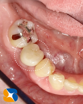 安全なインプラント　正確なポジションのインプラント　アフターケアーを考慮した設計