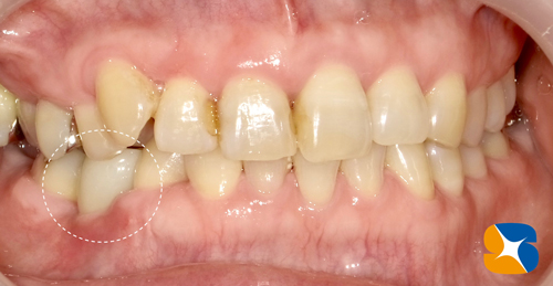 インプラント　奈良　生駒　石切　大阪