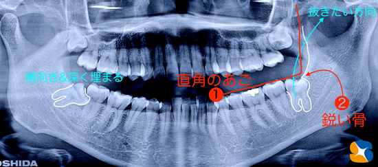 保険　静脈鎮静法を使った横向き親知らず