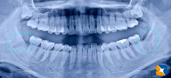 保険　静脈鎮静法を使った横向き親知らず