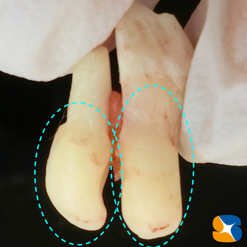 保険　静脈鎮静法を使った横向き親知らず