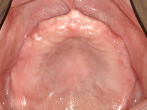 総入れ歯のインプラント