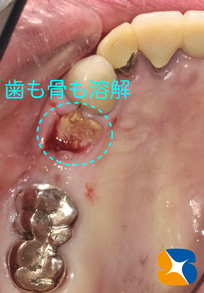 10年越え3連結のブリッジの結末