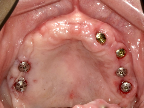 歯茎を切らないインプラント施術