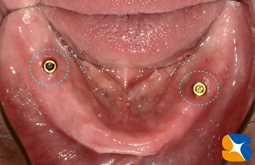 外れない下の全部入れ歯