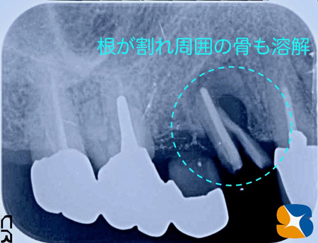 支えきれずブリッジの土台の根が割れる