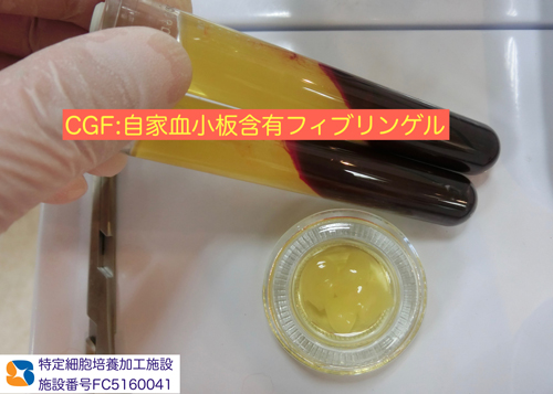 外れない下の全部入れ歯