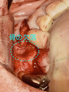 根が割れている周囲の骨が腐敗
