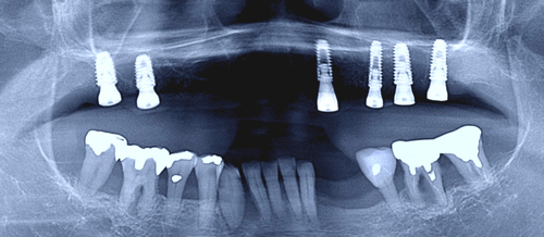 眠りながらのインプラント施術　大阪　奈良　生駒