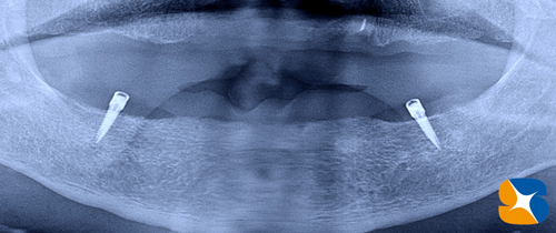 外れない下の全部入れ歯