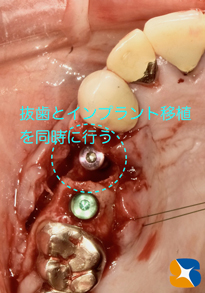 抜歯とインプラント移植と骨作り