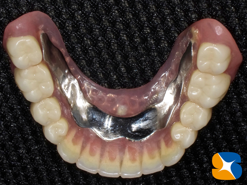 外れない下の全部入れ歯