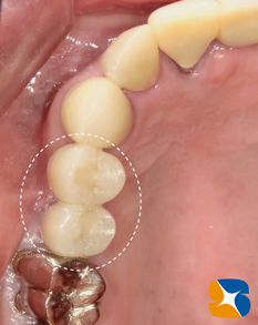 高齢者のインプラント　ブリッジや入れ歯は歯の負担が大きい