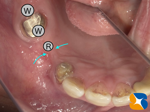 永年のブリッジで負担過多　亀裂　ヒビ