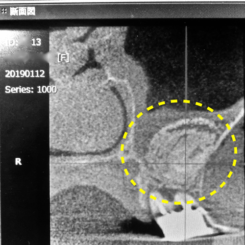 安心　安全　無添加の自己血液由来　フィブリノーゲン
