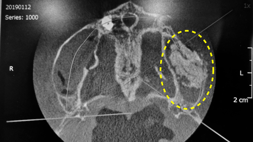 安心　安全　無添加の自己血液由来　フィブリノーゲン