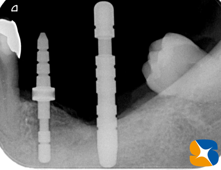 インプントの正しい移植位置を確認