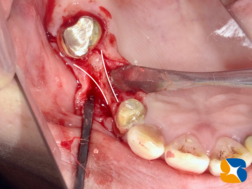 ２㎜幅の細くて薄い骨質