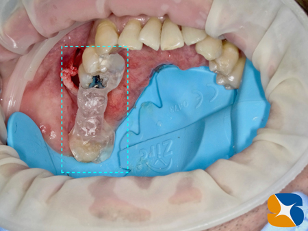 手術事故防止　インプラントの狂いのない安全位置ナビゲーターガイドを無料実地