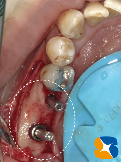 インプラント移植した日に仮歯を設置